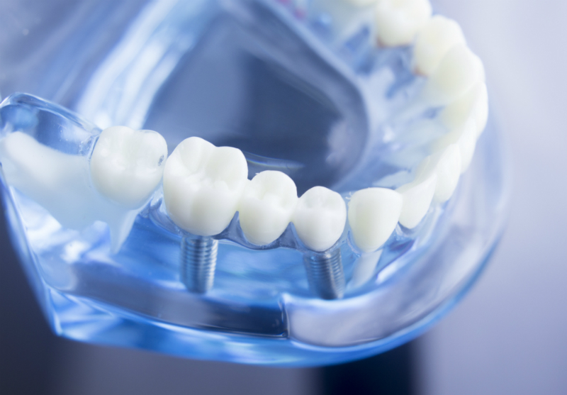 What Are Some Important Facts That I Should Know About Dental Implants?