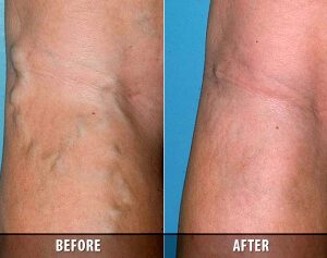 Options For Spider Vein Removal